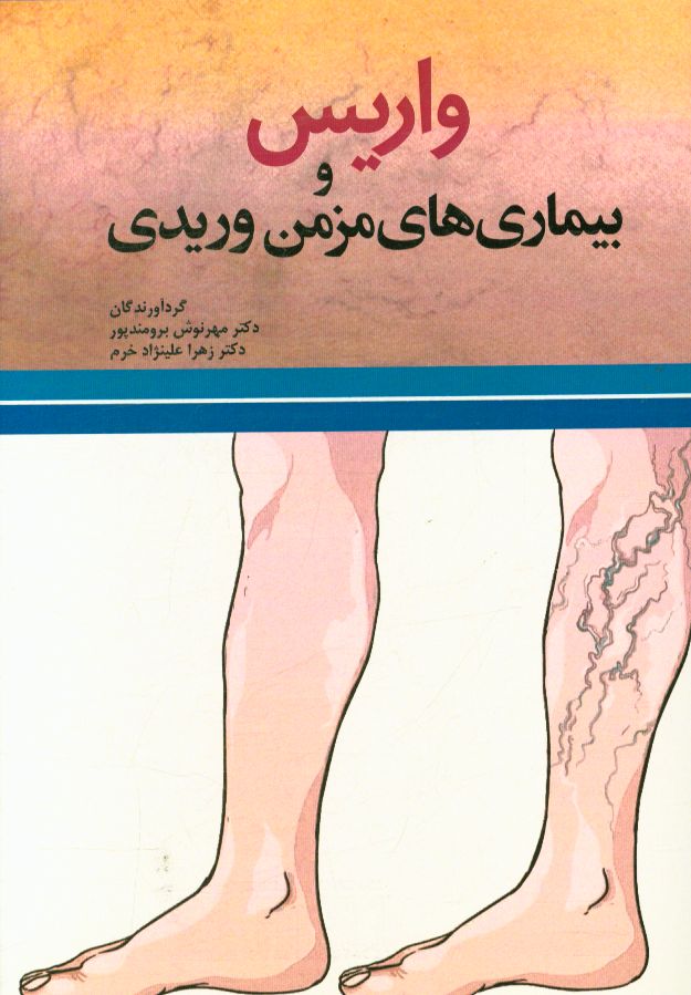 واریس و بیماری‌های مزمن وریدی