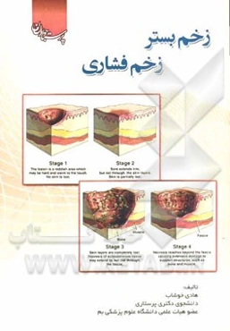 زخم بستر، زخم فشاری