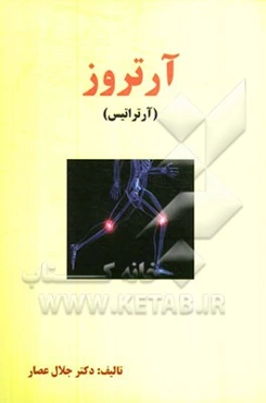 آرتروز (آرتراتیس)