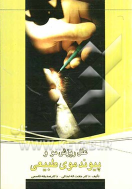 علل ریزش مو و پیوند موی طبیعی