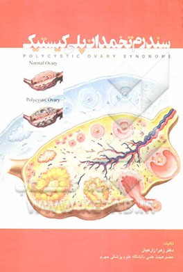 سندروم تخمدان‌های چندکیستی (پلی کیستیک