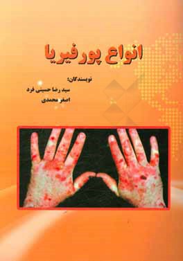 انواع پورفیریا