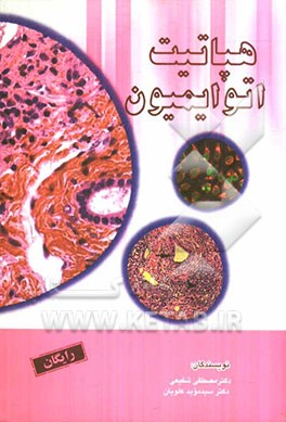 هپاتیت اتوایمیون