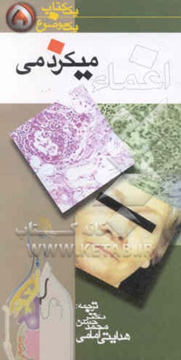 بیماری اغماء میکزدمی