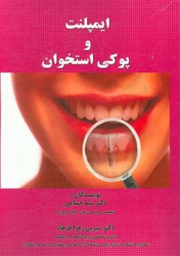 ایمپلنت و پوکی استخوان