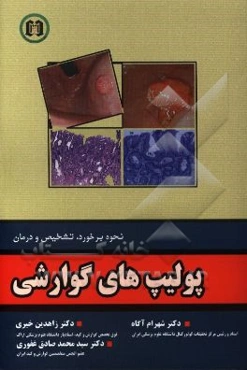 پولیپ‌های گوارشی