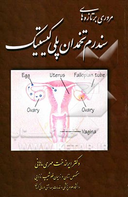 مروری بر تازه‌های سندرم تخمدان پلی‌کیستیک