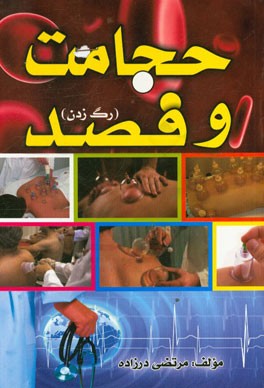 حجامت و فصد (رگ‌زدن)