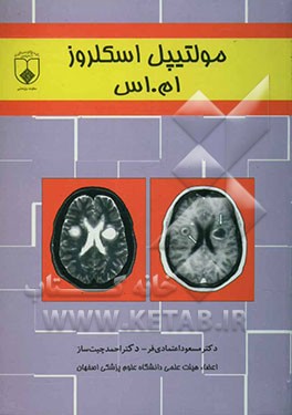 مولتیپل اسکلروز (ام. اس