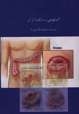 استومی و مراقبت از آن