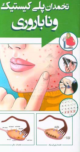 تخمدان پلی‌کیستیک و ناباروری