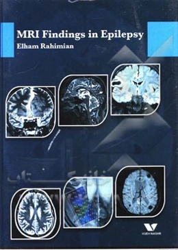 MRI findings in epilepsy