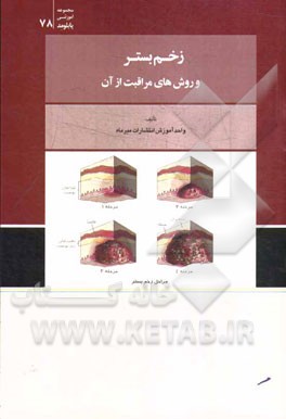 زخم بستر و روش‌های مراقبت از آن