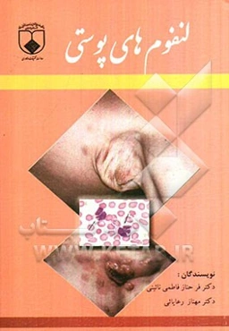 لنفوم‌های پوستی