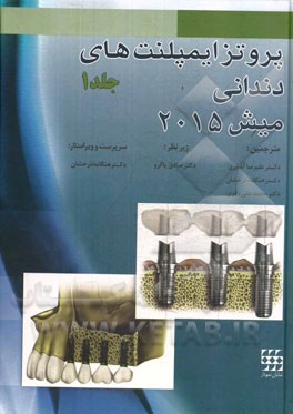 پروتز ایمپلنت‌های دندانی میش 2015