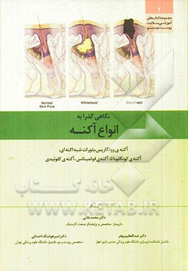 نگاهی گذرا به انواع آکنه: آکنه‌ی وولگاریس، بثورات شبه آکنه‌ای، ...