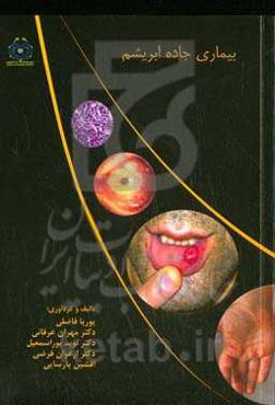 بیماری جاده ابریشم